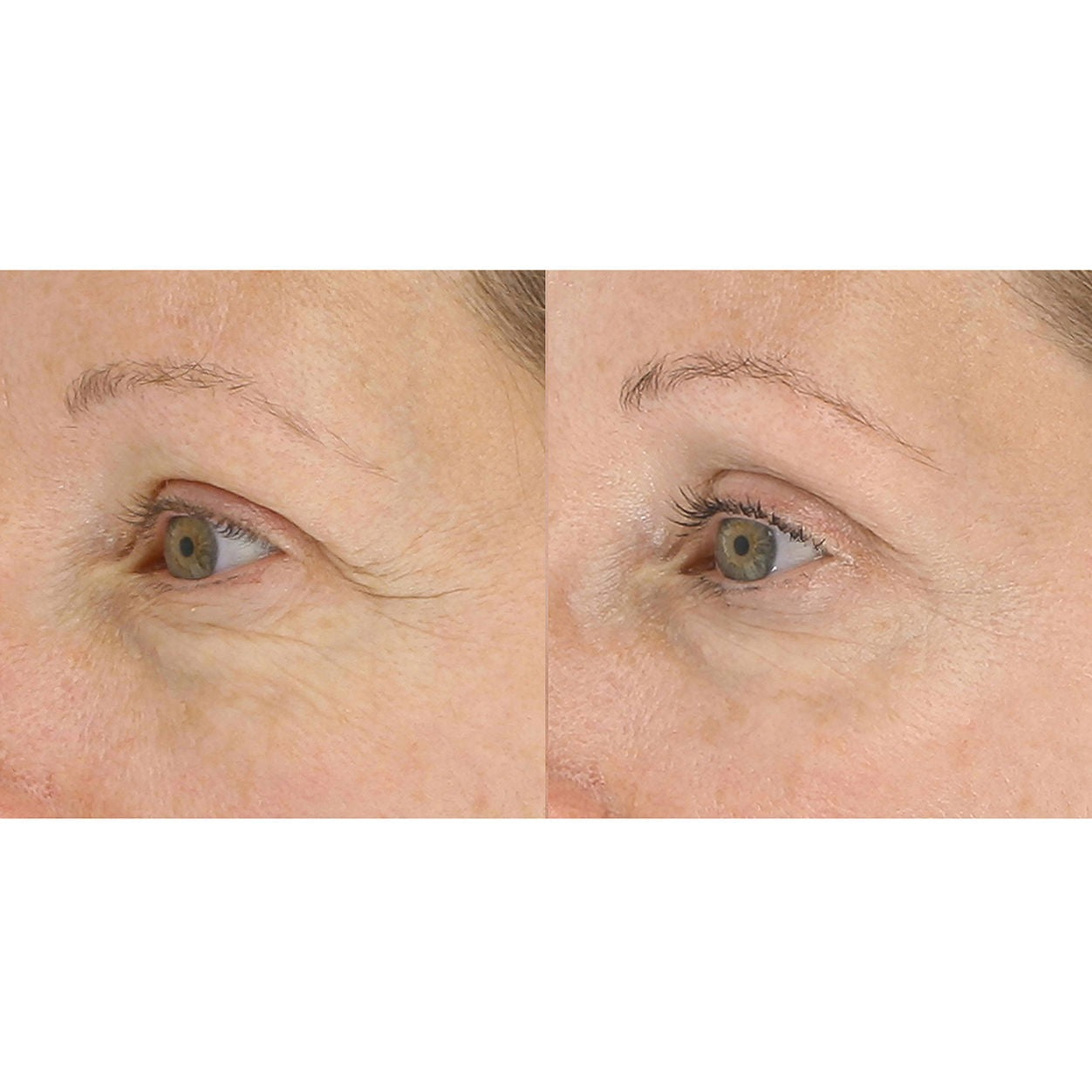 LightStim for Wrinkles