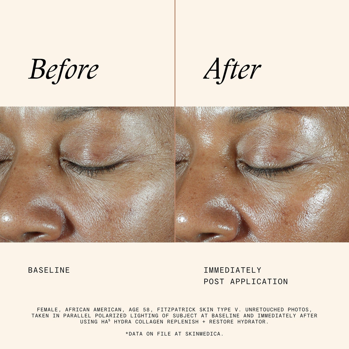 Post Micro-Needling + Injection Bundle