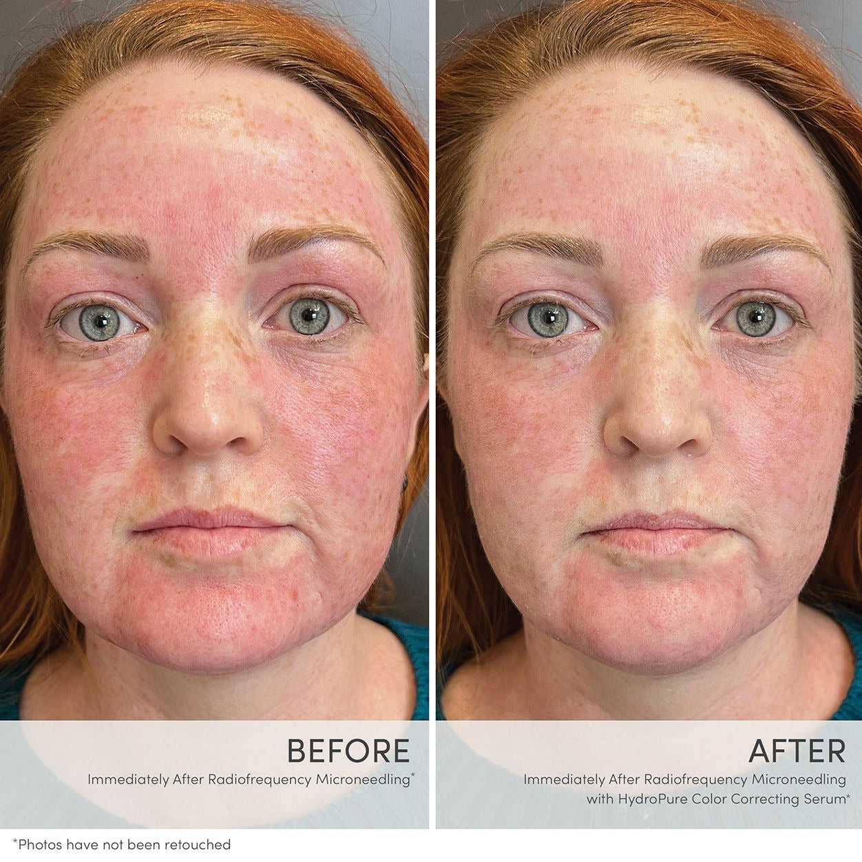 HydroPure Color Correcting Serum with Hyaluronic Acid and CoQ10