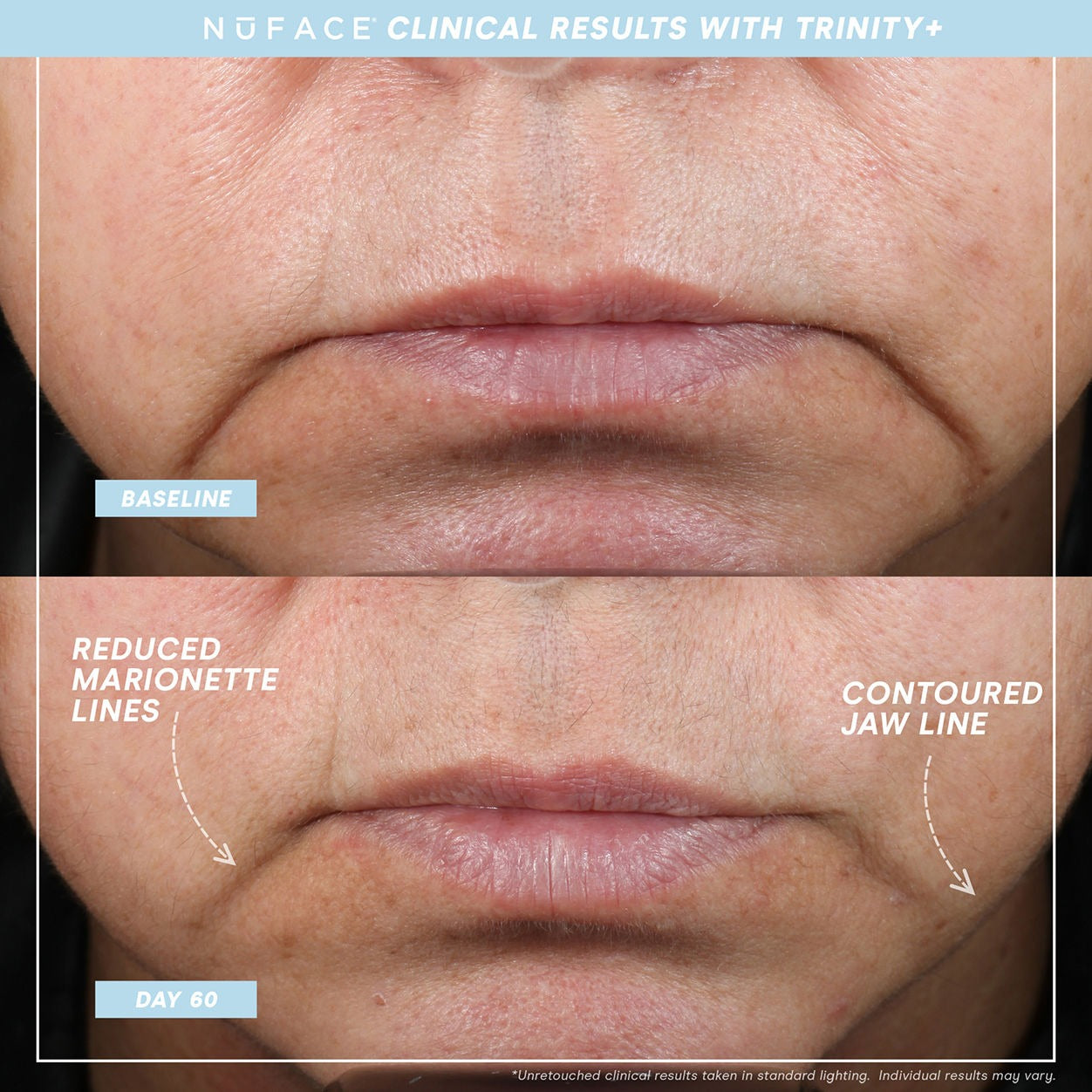 Trinity+ and Effective Lip and Eye Attachment