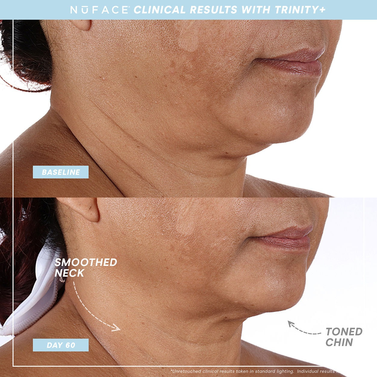 Trinity+ and Effective Lip and Eye Attachment